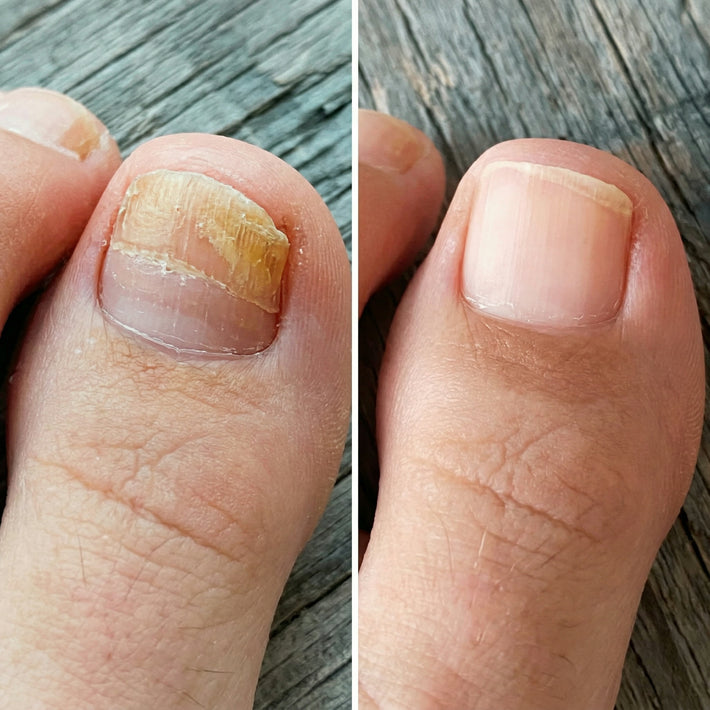 Antes y después uña con hongo