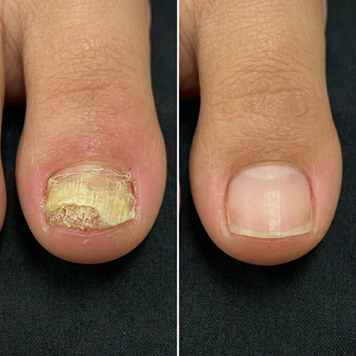 Antes y después uña con hongo