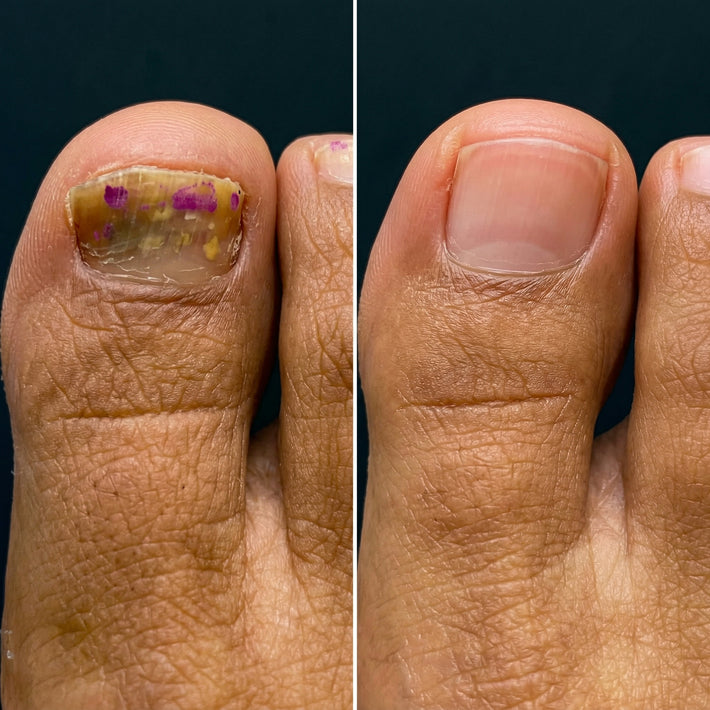 Antes y después uña con hongo