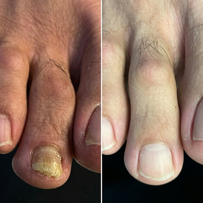 Antes y después uña con hongo