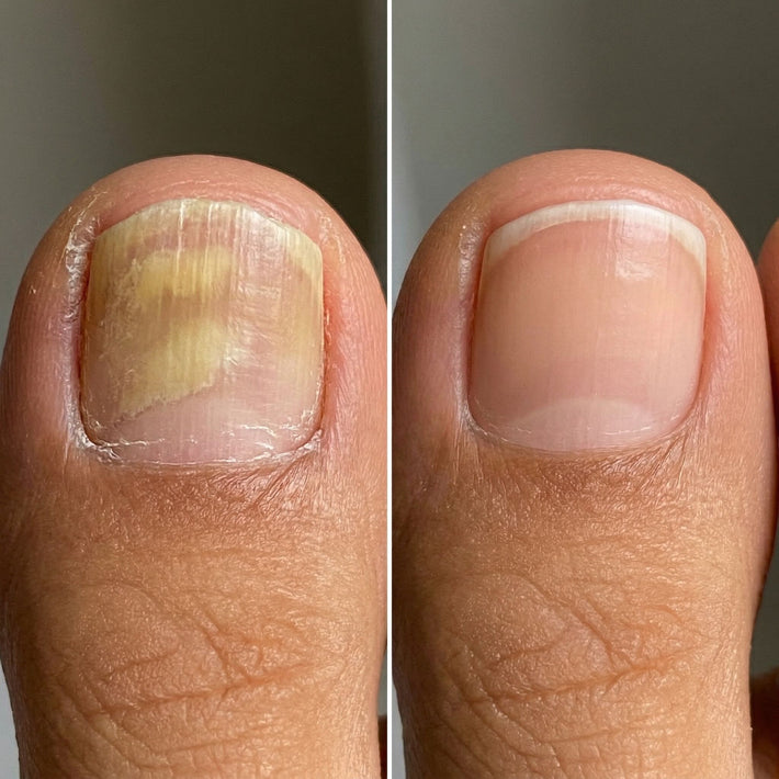 Antes y después uña con hongo